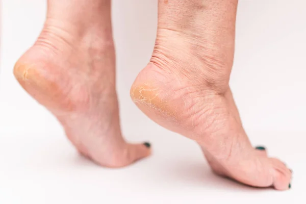 Closeup Cracks Woman Heels Isolated White Background Health Concept — Stock Photo, Image