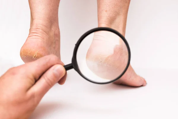 Closeup Highly Dry Heels Woman White Background Magnifying Glass Doctors — Stock Photo, Image