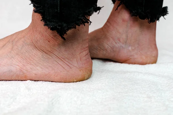 Semelles Pieds Sèches Fissurées Femmes Pieds Avec Des Talons Secs — Photo