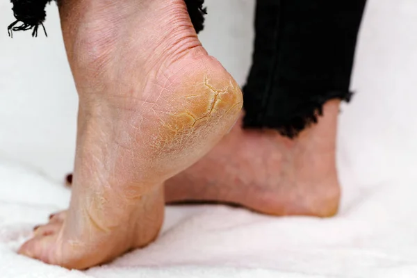 Ξηρά Και Ραγισμένα Πέλματα Ποδιών Γυναικεία Πόδια Στεγνά Τακούνια Ραγισμένο — Φωτογραφία Αρχείου