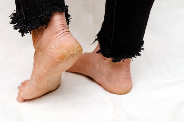 Adult Woman Dehydrated Skin Heels Female Feet Cracks Closeup — Stock Photo, Image