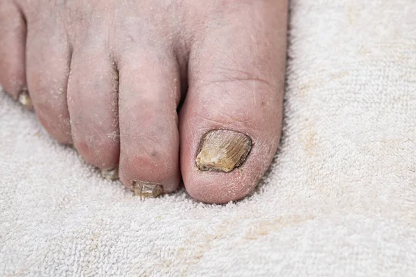 Infecção Por Fungos Nas Unhas Dos Pés Homem Fundo Branco — Fotografia de Stock