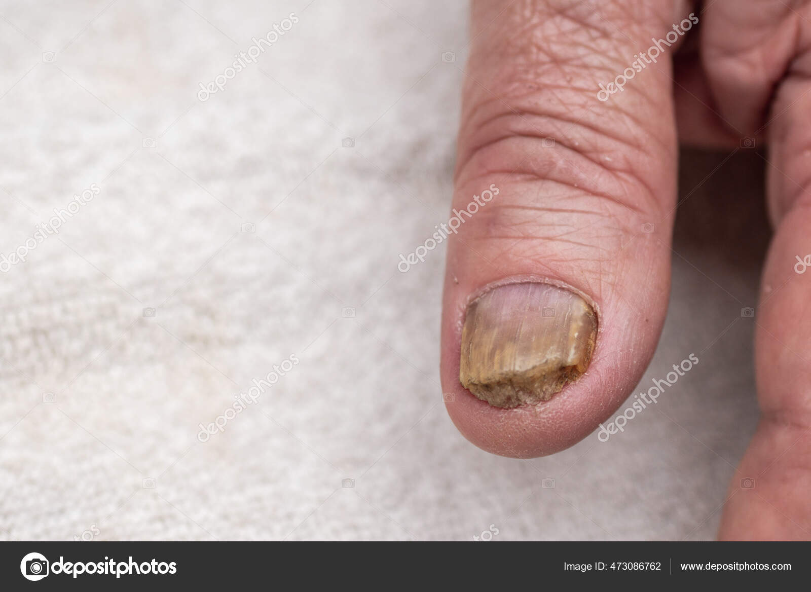 3 Ways to Hide Nail Fungus - wikiHow