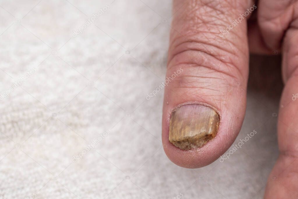 Nail fungus infection on the big finger. Fungal infection on nails hand, finger with onychomycosis.Close up.