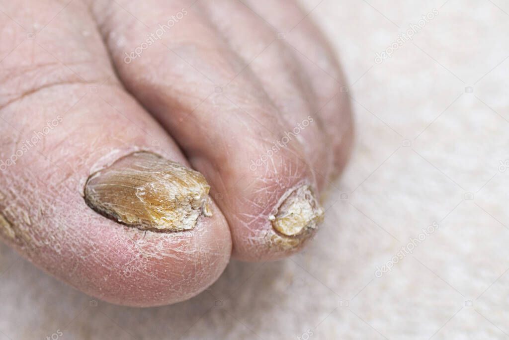 Fungus Infection on Nails of Man's Foot.White background,indoors shot.