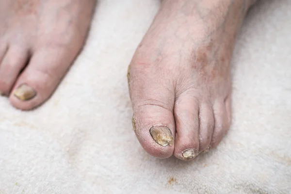 Fungus Infection on Nails of Man\'s Foot.White background,indoors shot.