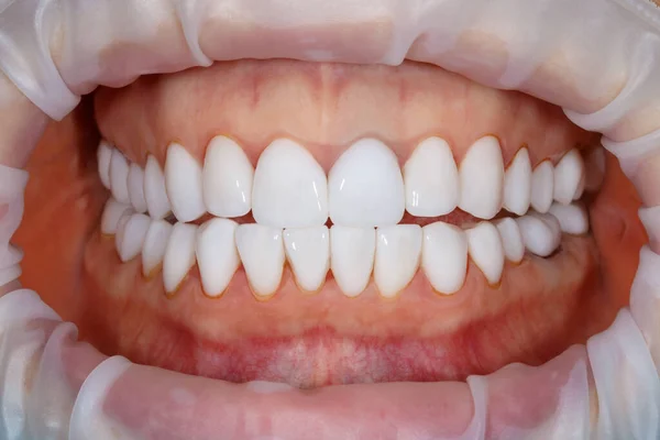 Dental of teeth close up. Teeth whitening image. Bleach veneers. Dental photography.