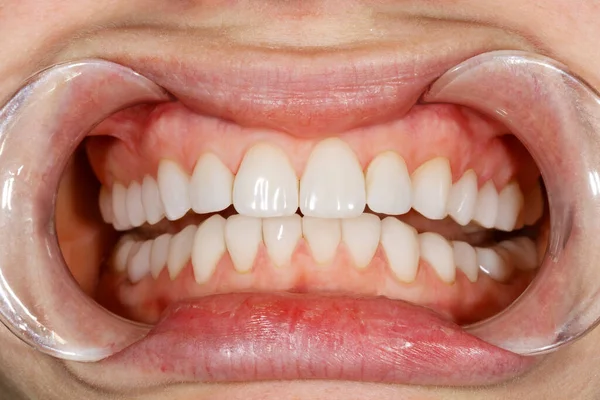 Dental Teeth Treatment Photo Teeth Close Teeth Whitening Image Treatment Imagen de archivo