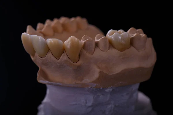 Mold of teeth. Gypsum model plaster of teeth. Plaster cast of teeth from human in preparation for producing a dental crown. Stomatologic plaster cast, molds of human jaws and teeth on black background. Dentistry and orthodontics concept.
