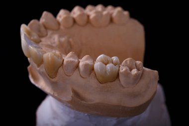 Diş kalıbı. Alçıtaşı model diş sıvası. Diş macunu üretmek için insan dişlerinden alçı döküm. Diş ve ortodonti konsepti.