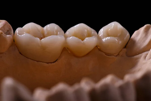 Плесень Зубов Гипсовая Модель Гипса Зубов Отлитые Гипса Зубы Человека Стоковое Изображение