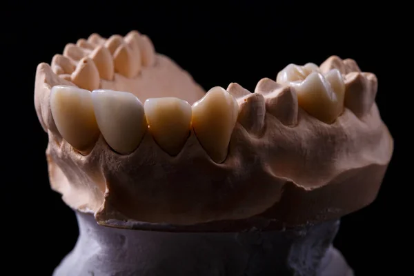 Zahnschimmel Gips Modell Gips Der Zähne Gipsabguss Von Menschlichen Zähnen — Stockfoto