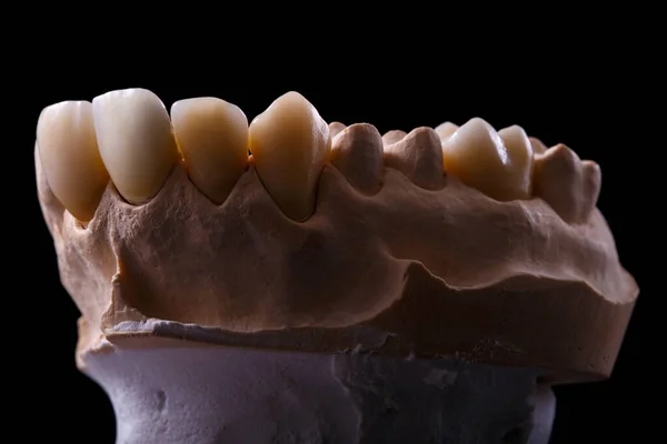 歯の型 歯の石膏モデル石膏 歯科冠を生産するための準備として 人間からの歯の石膏キャスト 歯と歯列矯正の概念 — ストック写真