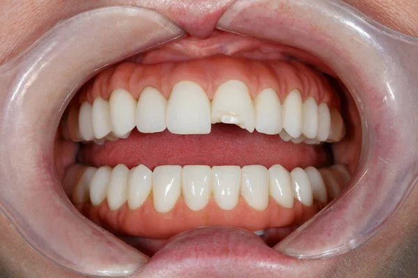 Стоматология Зубов Перед Лечением Крупным Планом Фото Зубов Образ Отбеливания Стоковое Фото