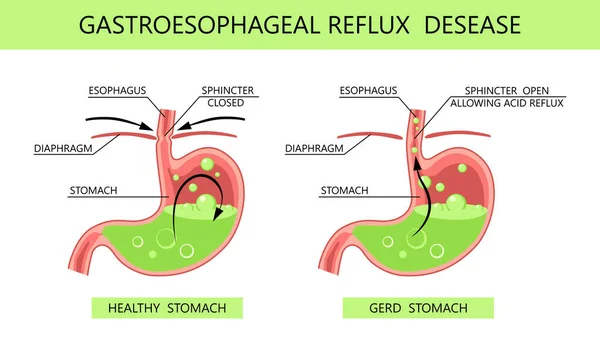 Gastroözofagus reflü hastalığı. Asit reflüsü, mide ekşimesi ve tıbbi vektör illüstrasyonlu gerd bilgisi. Sağlıklı ve hasta bir mide. Tıp anatomisi sağlıklı, organ ve hastalık GERD bilgileri
