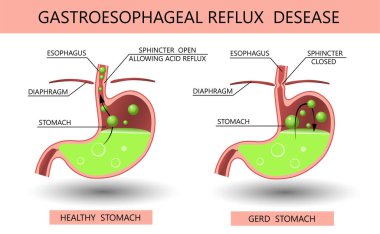 Gastroözofagus reflü hastalığı 3D. Asit reflüsü, mide ekşimesi ve tıbbi vektör illüstrasyonlu gerd bilgisi. Sağlıklı ve hasta bir mide. Tıbbi anatomi sağlıklı organ ve hastalık. GERD bilgisel