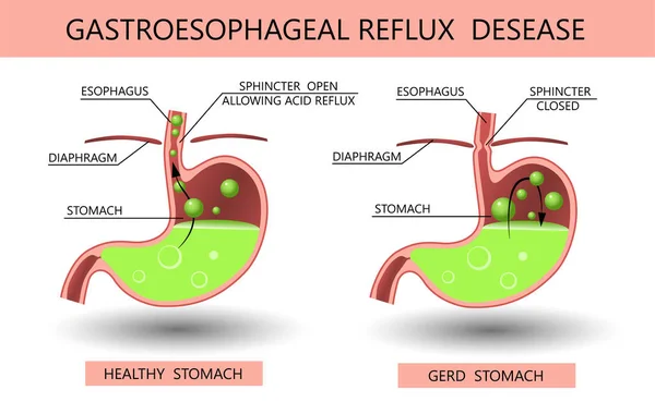 Gastroesophageal Reflux Disease Acid Reflux Heartburn Gerd Infographic Medical Vector — Stock Vector
