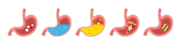 Conjunto de estómago sano y enfermo. Dolor de estómago, gastritis, indigestión, vómitos, problemas de acidez estomacal. Sistema digestivo.Anatomía de la medicina estómago humano.Ilustración plana vectorial aislada sobre fondo blanco — Vector de stock