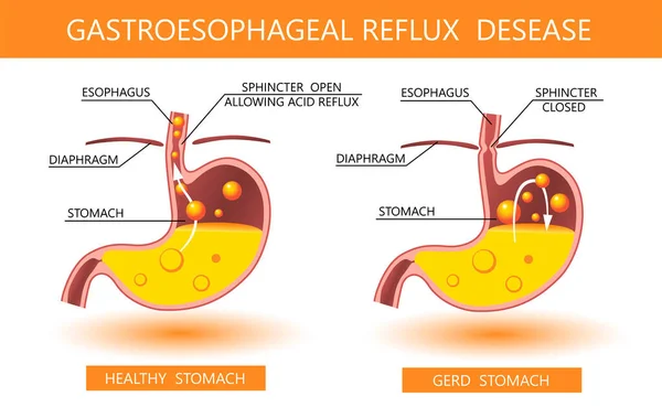 Gastroözofagus reflü hastalığı 3D. Asit reflüsü, mide ekşimesi ve tıbbi vektör illüstrasyonlu gerd bilgisi. Sağlıklı ve hasta bir mide. Tıbbi anatomi sağlıklı organ ve hastalık. GERD bilgisel