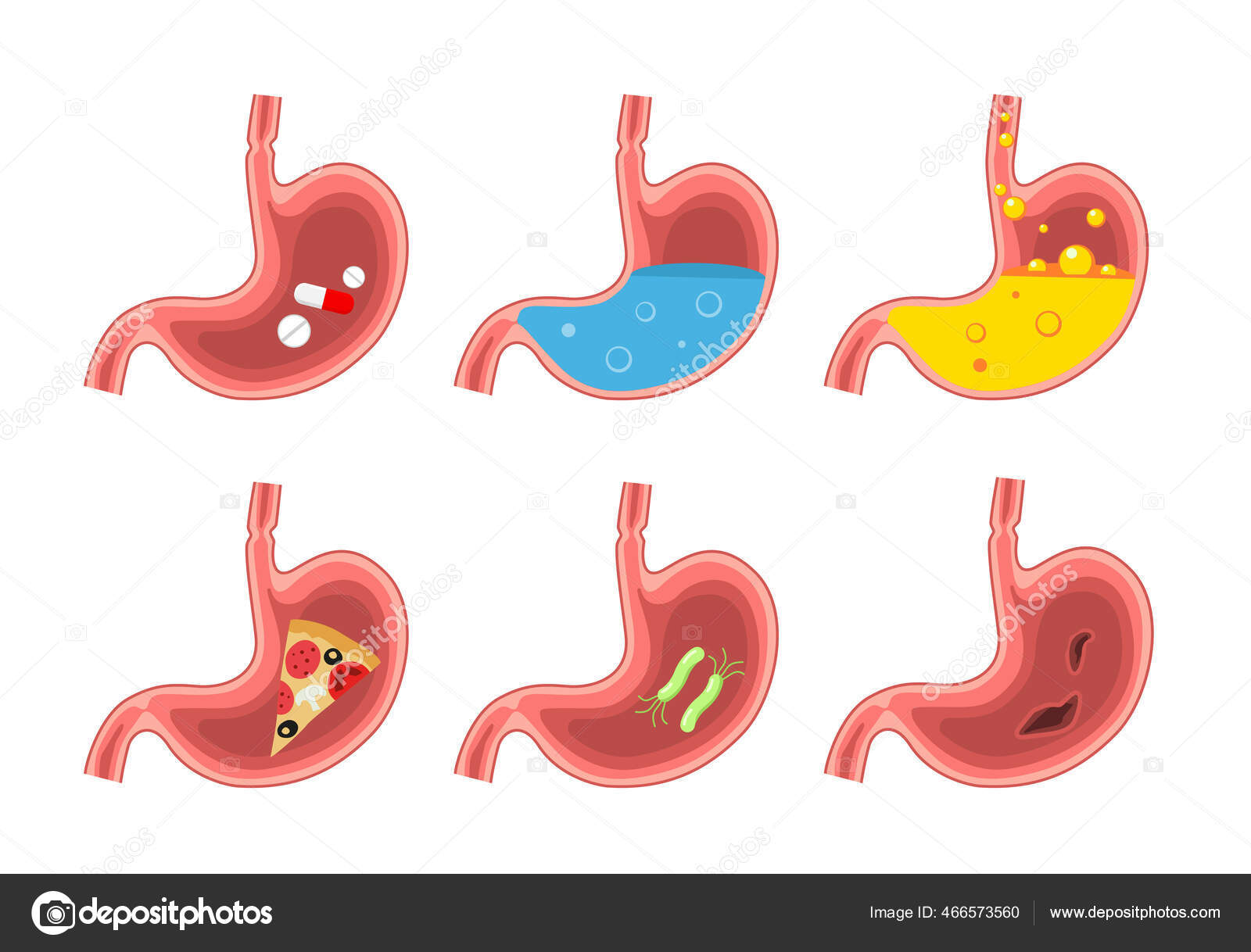 Set of healthy and sick stomach. Stomach pain, gastritis, indigestion
