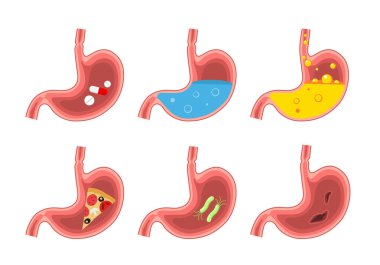 Set of healthy and sick stomach. Stomach pain, gastritis, indigestion, vomiting, heartburn problem. Digestive system.Medicine anatomy human stomach.Vector flat illustration isolated on white backgroun clipart