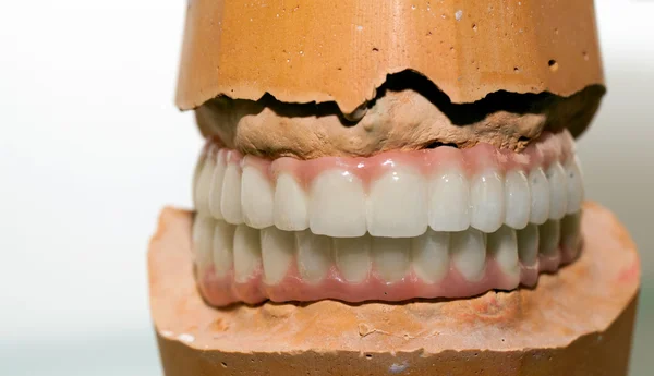 Zirkonium porslin tand plattan i tandläkare butik — Stockfoto