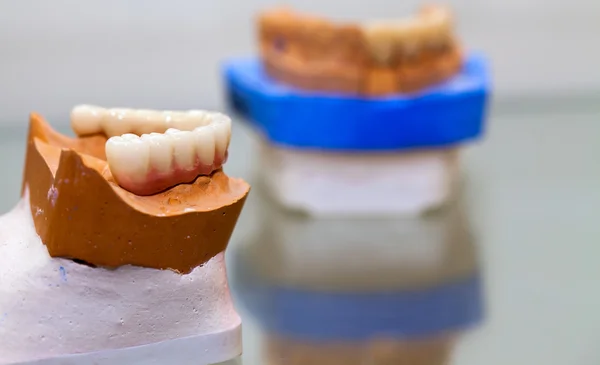 Placa de dentes de porcelana de zircônio na loja de dentista — Fotografia de Stock