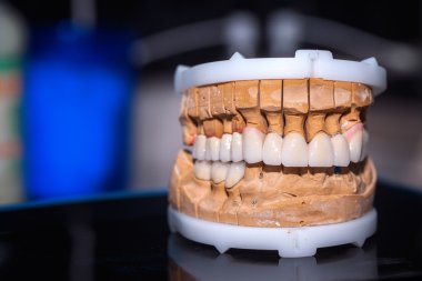 Dental Prosthesis Porcelain Zirconium Tooth clipart