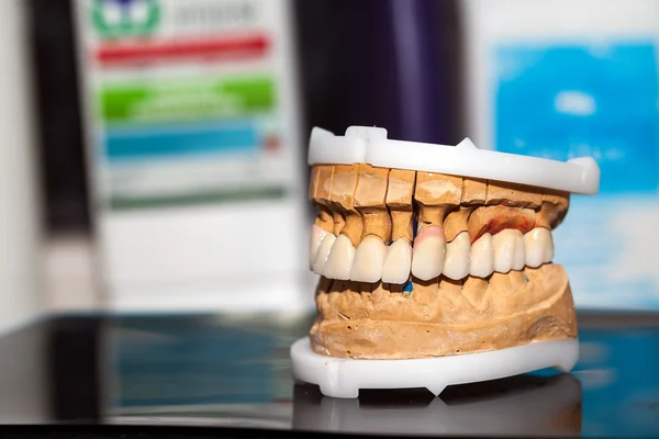 Diş Protez porselen zirkonyum diş — Stok fotoğraf