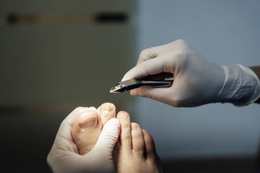 Yetişkin bir adamın ayaklarına nasırlı lateks eldiven takan bir ayak hastalıkları uzmanının yakın çekimi..