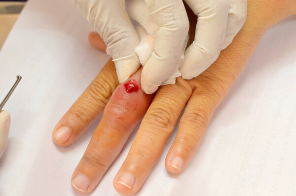 squeezing pus infected wound