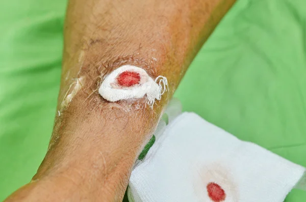 Before dressing wound — Stock Photo, Image