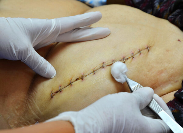 cleaning suture wound