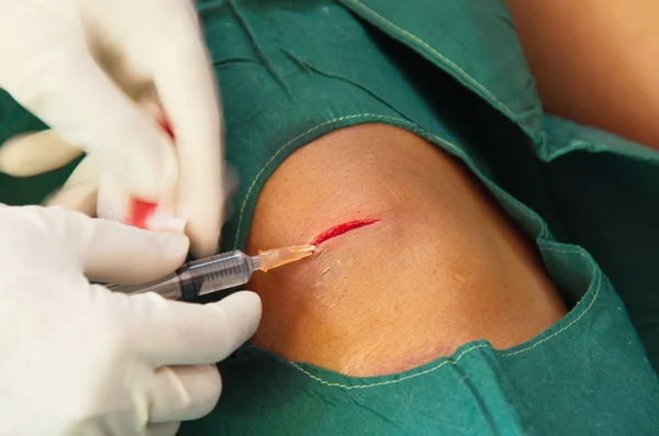 Injecting before suture. — Stock Photo, Image