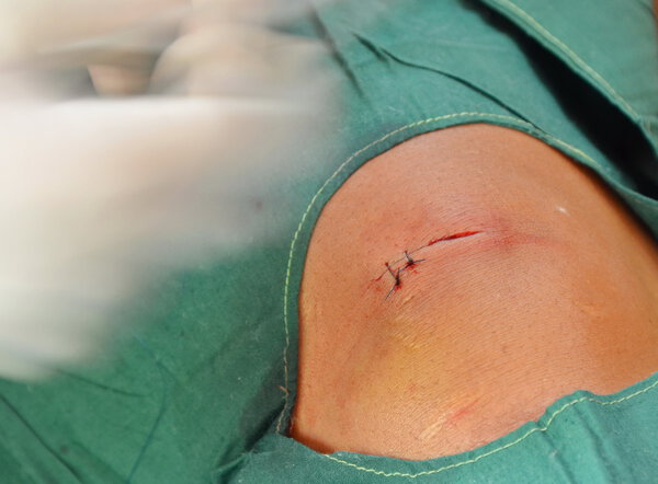 Incision wound suture.