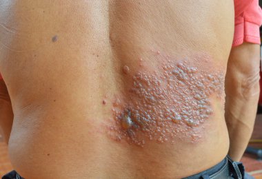 Herpes Zoster.