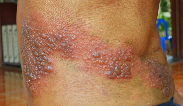 Infection from  herpes zoster virus. — 图库照片