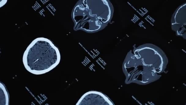Resonancia magnética del cerebro de un hombre mayor — Vídeo de stock