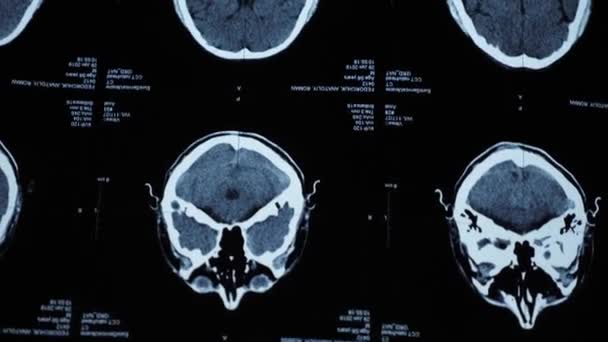 Resonancia magnética del cerebro de un hombre mayor — Vídeo de stock