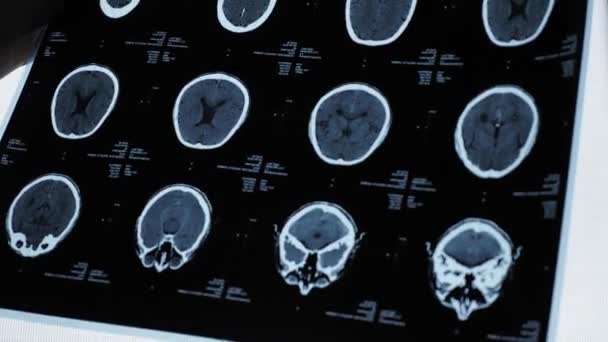 MRI mozku staršího muže — Stock video