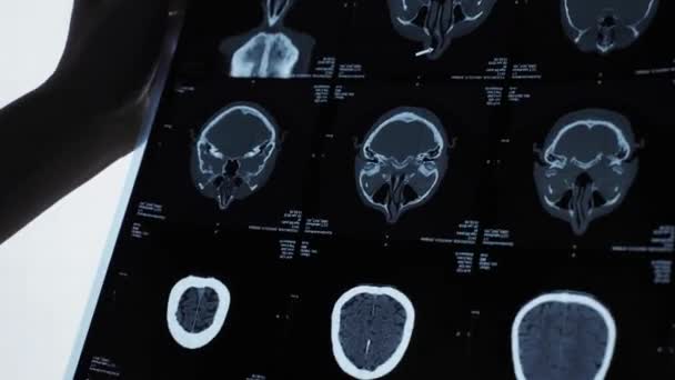 MRI van de hersenen van een oudere man — Stockvideo