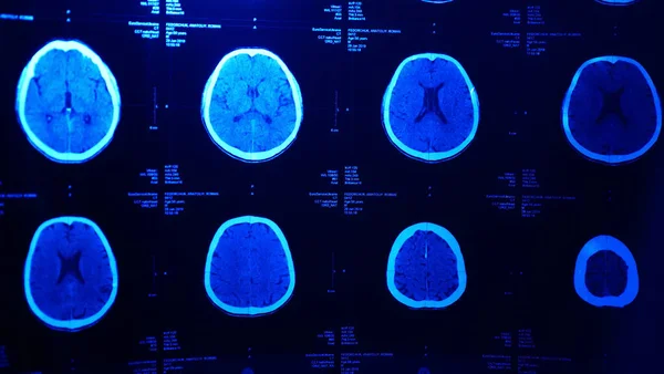 Travmadan sonra beyin MR 'ı.