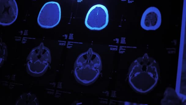 Resonancia magnética del cerebro de un hombre mayor — Vídeos de Stock