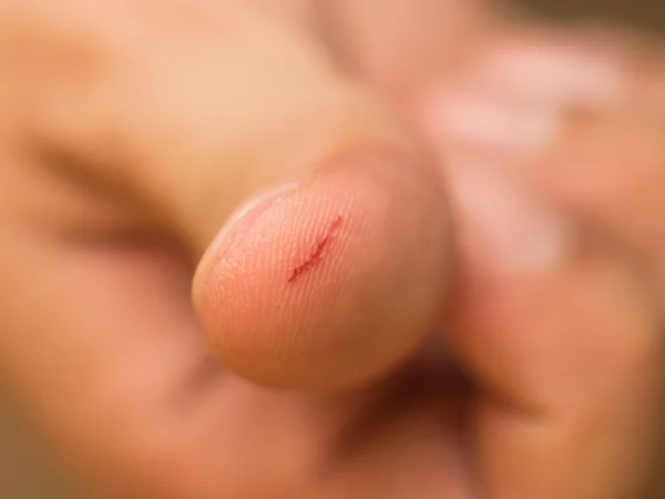 Thumb cut wound — Stock Photo, Image