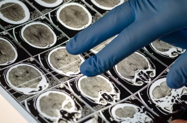 Mavi eldivenli bir el Brai 'nin röntgenini çeker.