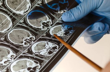 Beyin cerrahı, tomografi sonuçlarına göre...