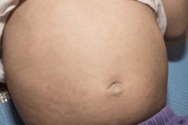 Ekzantemi subitum, Roseola Infantum, altıncı hastalık, seudo kızamıkçık bebek hasta