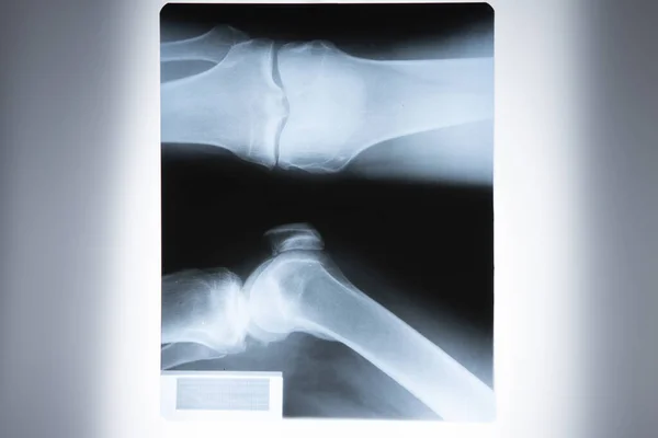 Close Ray Patient Knee Injury Hospital Reflective Board Viewing Radiographs — Stock Photo, Image