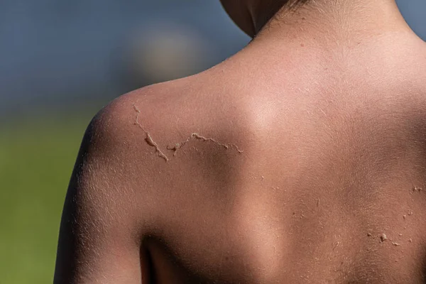 Skin peeling off the back of a small kid after being sunburned.