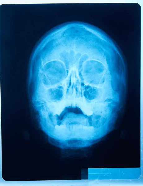 Obraz Filmu Rentgenowskiego Przodu Głowy Człowieka Wykonane Celu Zbadania Skul — Zdjęcie stockowe